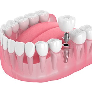 Illustration of a single dental implant.