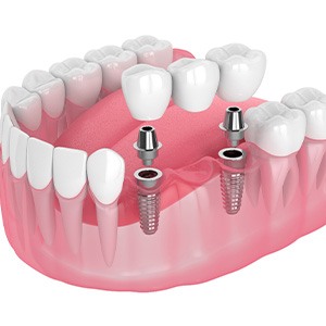 Illustration of an implant denture.
