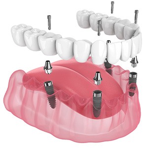 Illustration of an implant denture.