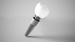Model of a dental implant