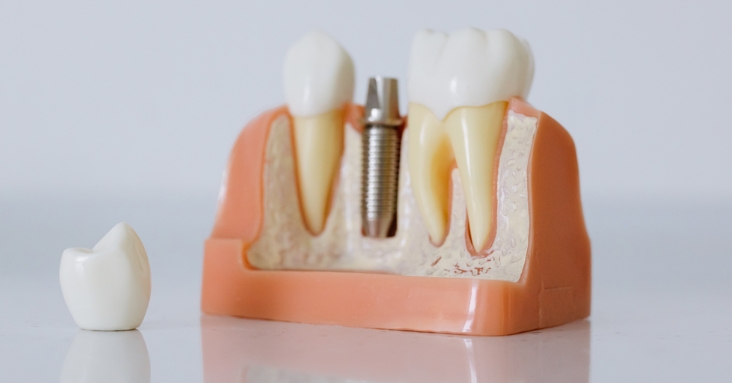 What to Expect During the Healing Process After Getting Dental Implants