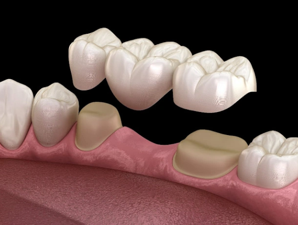 dental bridges in fort worth tx - titanium dental & implants