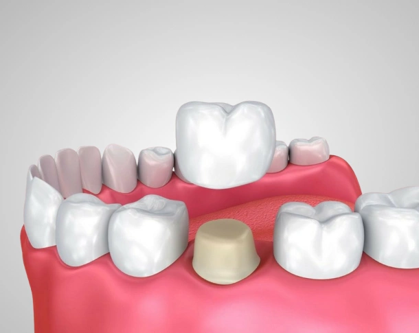 dental crowns in fort worth tx - titanium dental & implants