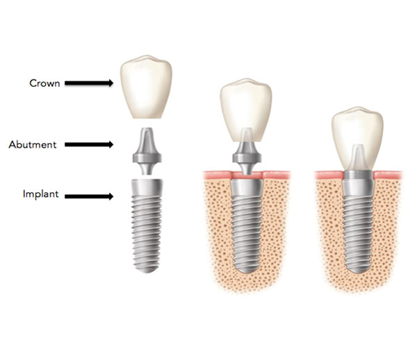 dental implants in fort worth tx - titanium dental & implants