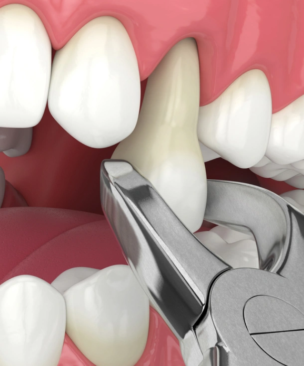surgical tooth extractions in fort worth tx - titanium dental & implants