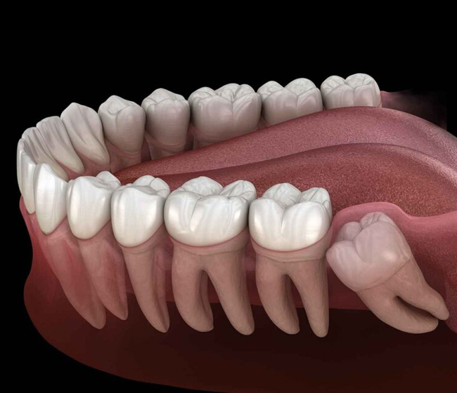 Wisdom Tooth Extractions in Fort Worth TX